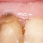 Periodoncia en Terrassa