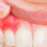 Gingivitis en Terrassa