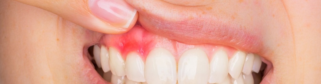 Gingivitis en Terrassa