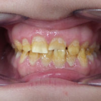 caso real estética dental en Terrassa