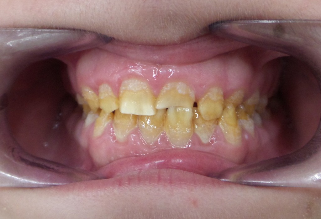 caso real estética dental en Terrassa caso real estética dental en Terrassa