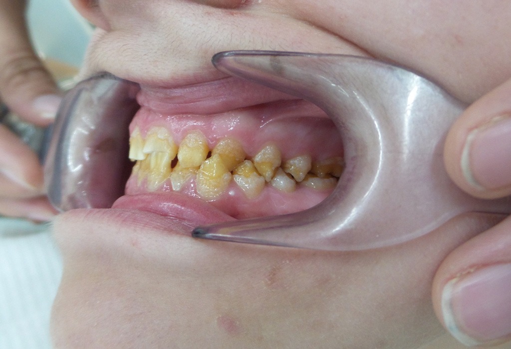 estética dental en Terrassa caso real estética dental en Terrassa