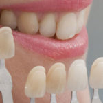 Blanqueamiento dental en Rubí