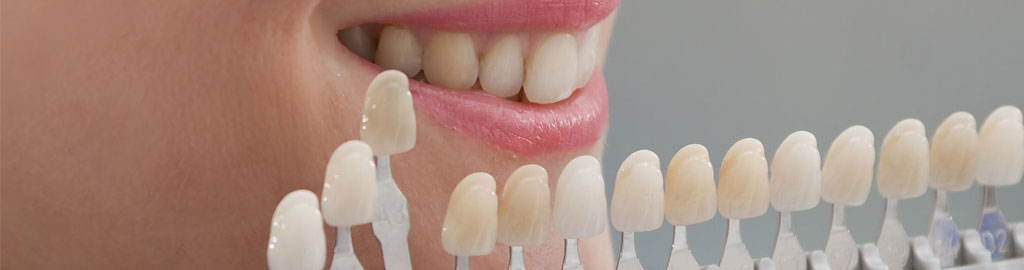 Preguntas frecuentes sobre blanqueamiento dental en Rubí