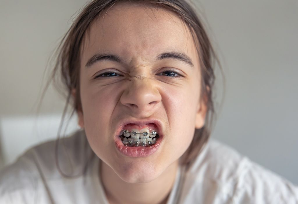 Urgencia dental con brackets