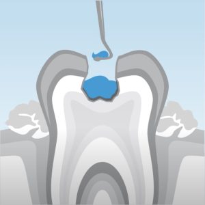 caries sin anestesia ni turbina