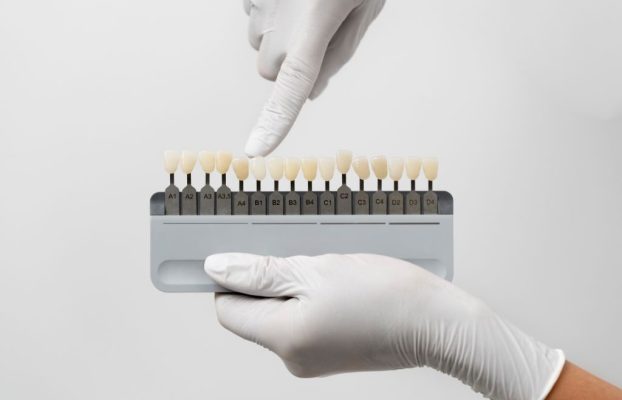 Carillas de composite vs. porcelana: Diferencias, duración y cuál elegir