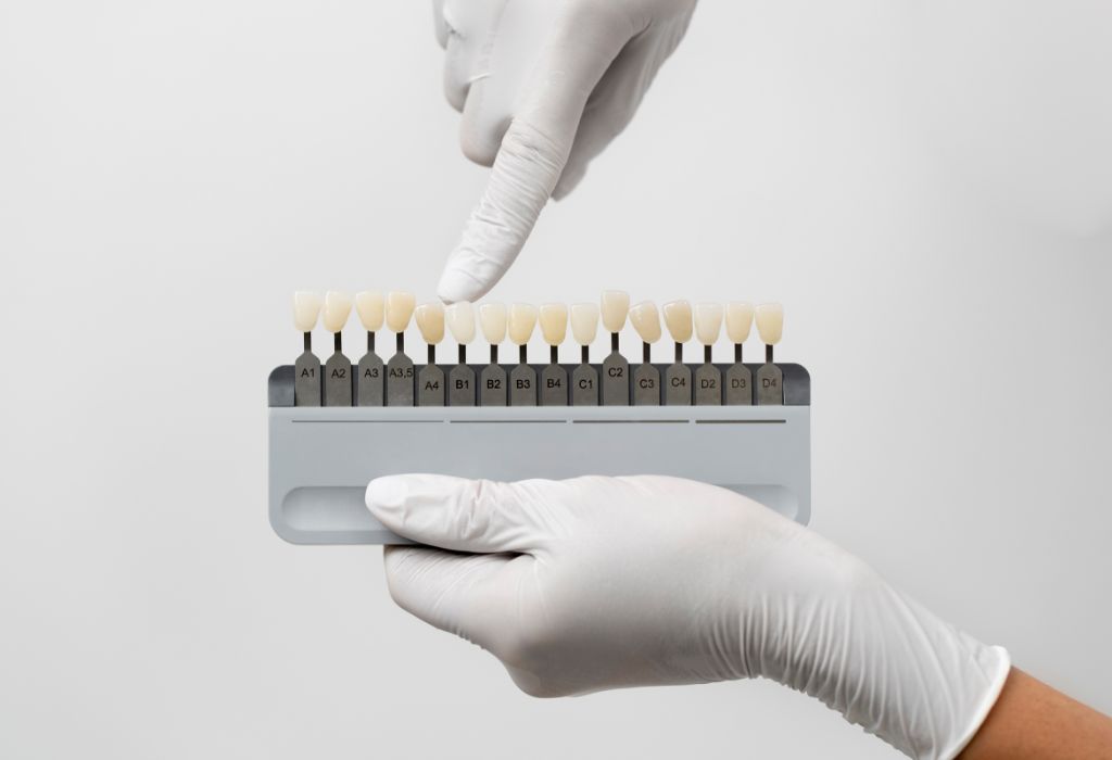Carillas de composite vs. porcelana: Diferencias, duración y cuál elegir