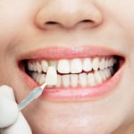 carillas dentales