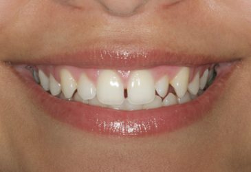 tratamiento completo en 1 visita carillas dentales