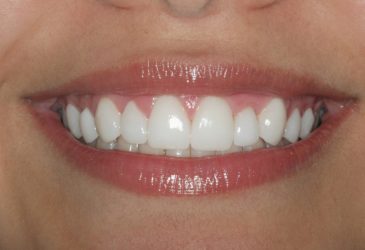 tratamiento completo en 1 visita carillas dentales