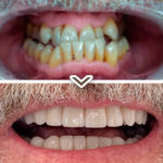 dientes antes y después