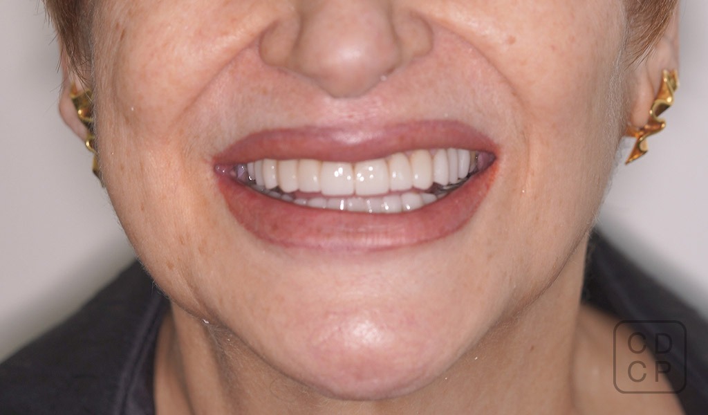caso real de rehabilitación dental caso real de rehabilitación dental