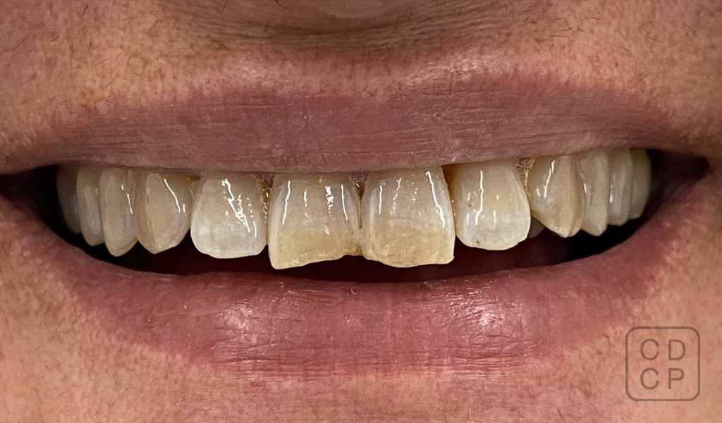 caso real de estética dental