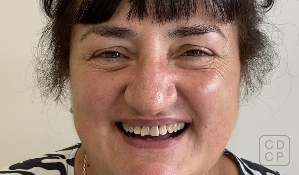 caso real de estética dental