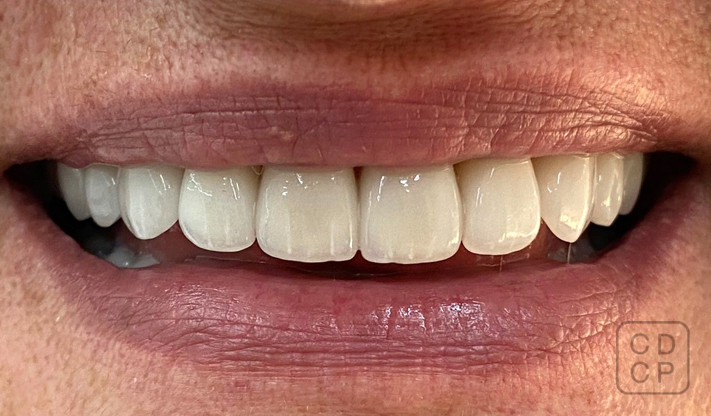 caso real de estética dental