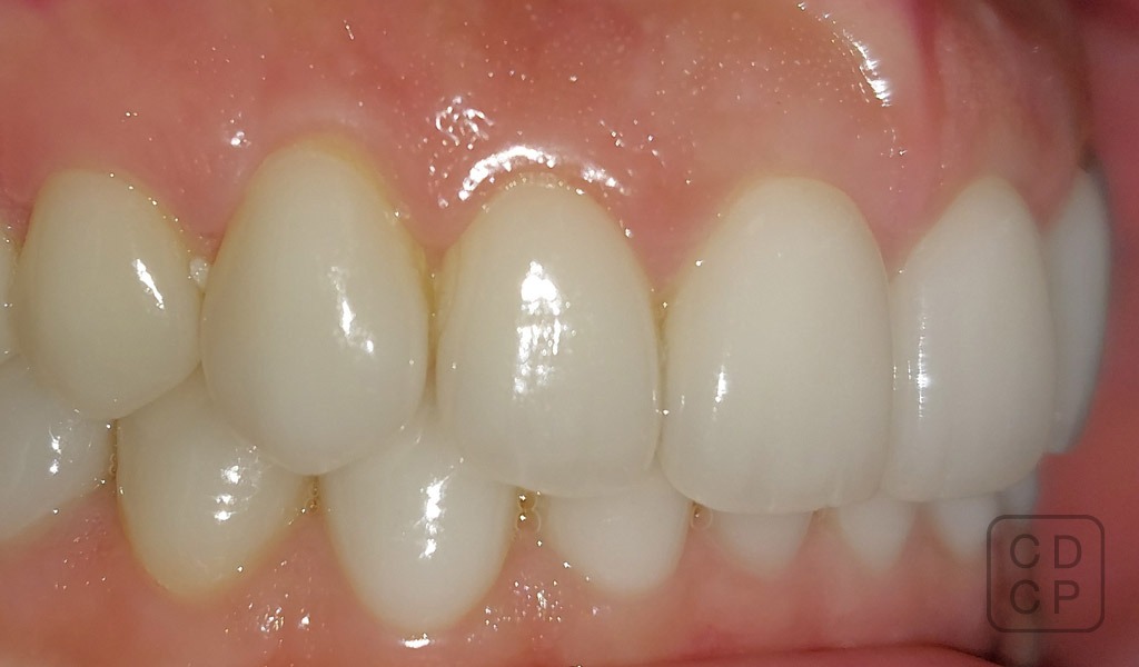 caso real de rehabilitación dental caso real de rehabilitación dental