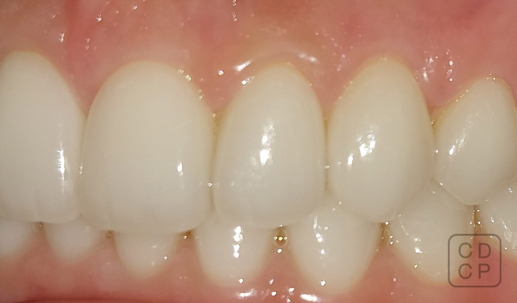 caso real de rehabilitación dental caso real de rehabilitación dental