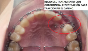 caso real ortodoncia Terrassa caso real ortodoncia Terrassa