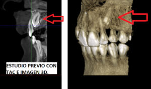 caso real ortodoncia Terrassa caso real ortodoncia Terrassa