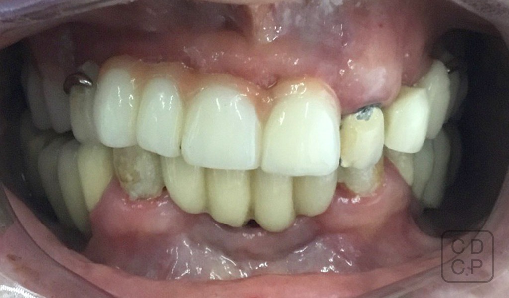 caso real de rehabilitación dental