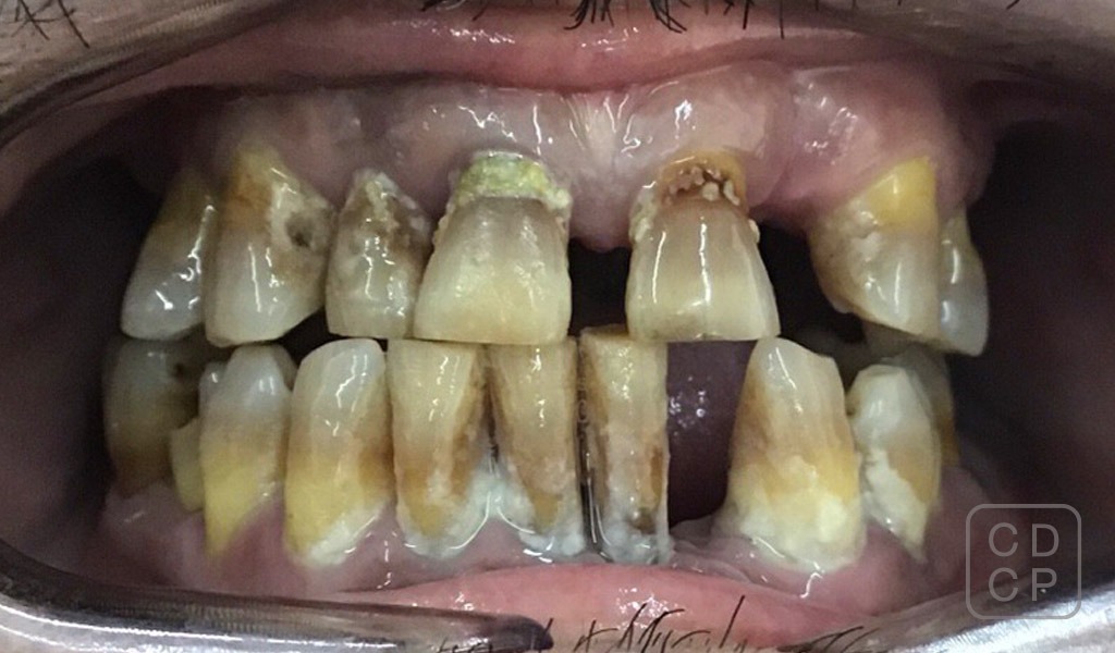 caso real con implantes dentales