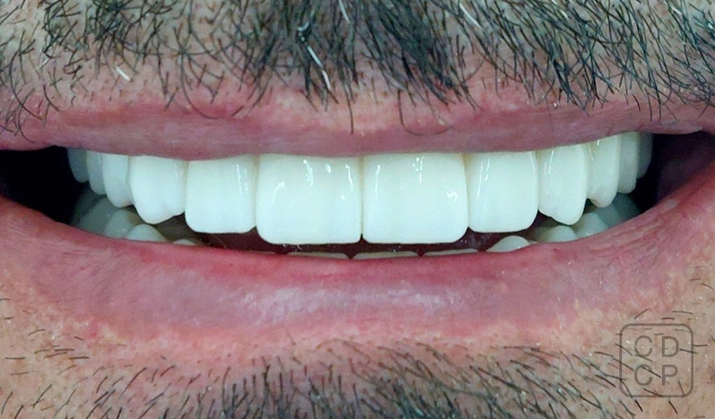 caso real con implantes dentales