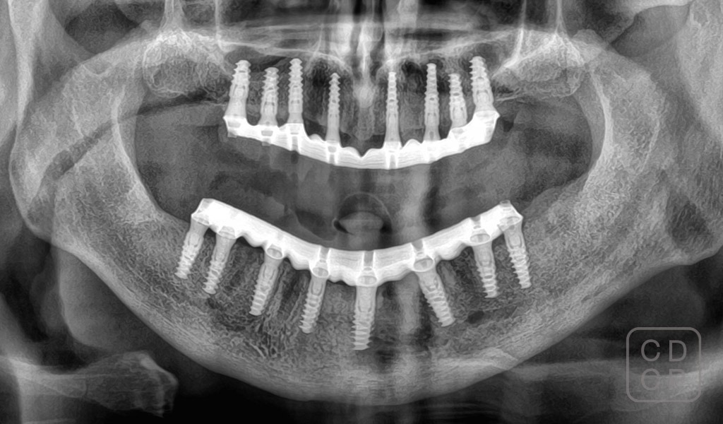 caso real con implantes dentales