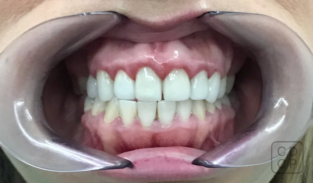 caso real de rehabilitación dental caso real de rehabilitación dental