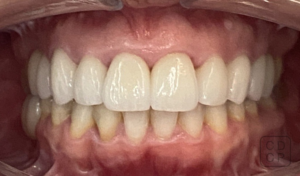 caso real de rehabilitación dental caso real de rehabilitación dental