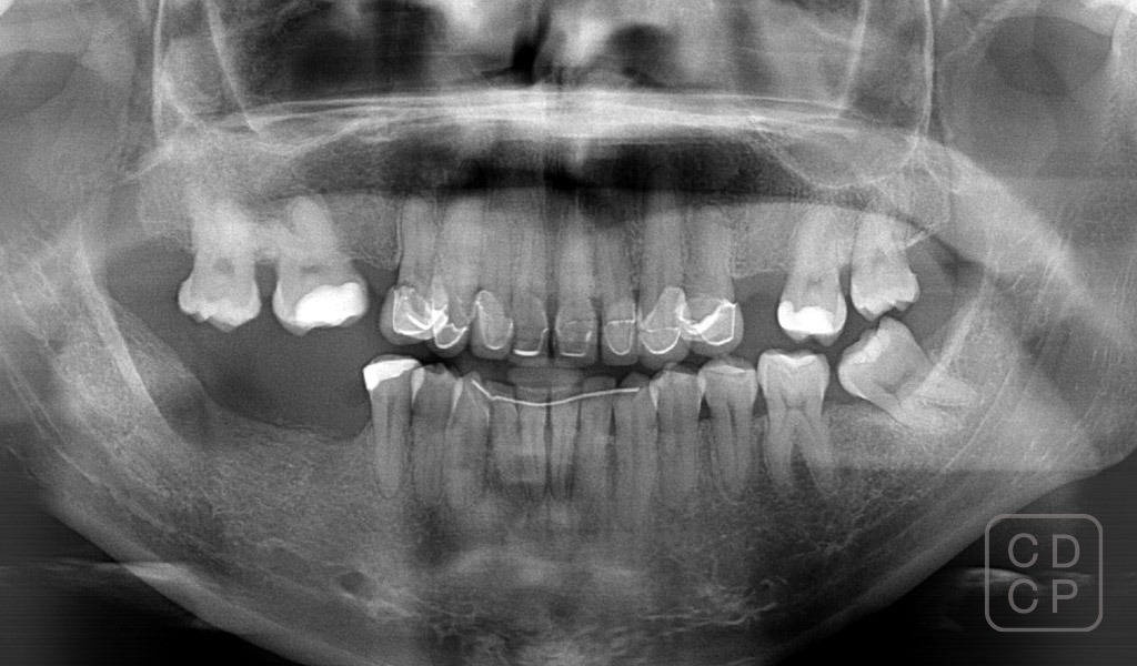 caso real de rehabilitación dental caso real de rehabilitación dental