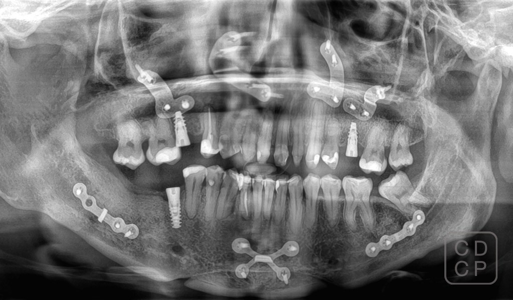 caso real de rehabilitación dental caso real de rehabilitación dental