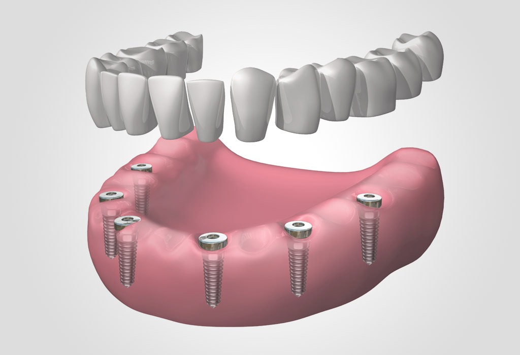 dentadura fija completa: cirugía maxilofacial