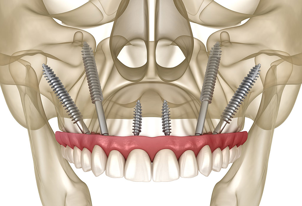 implantes dentales para personas sin hueso: cirugía maxilofacial