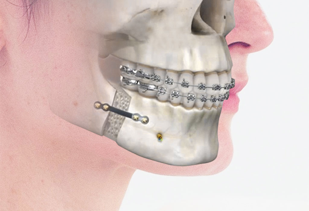 ortognática: cirugía maxilofacial