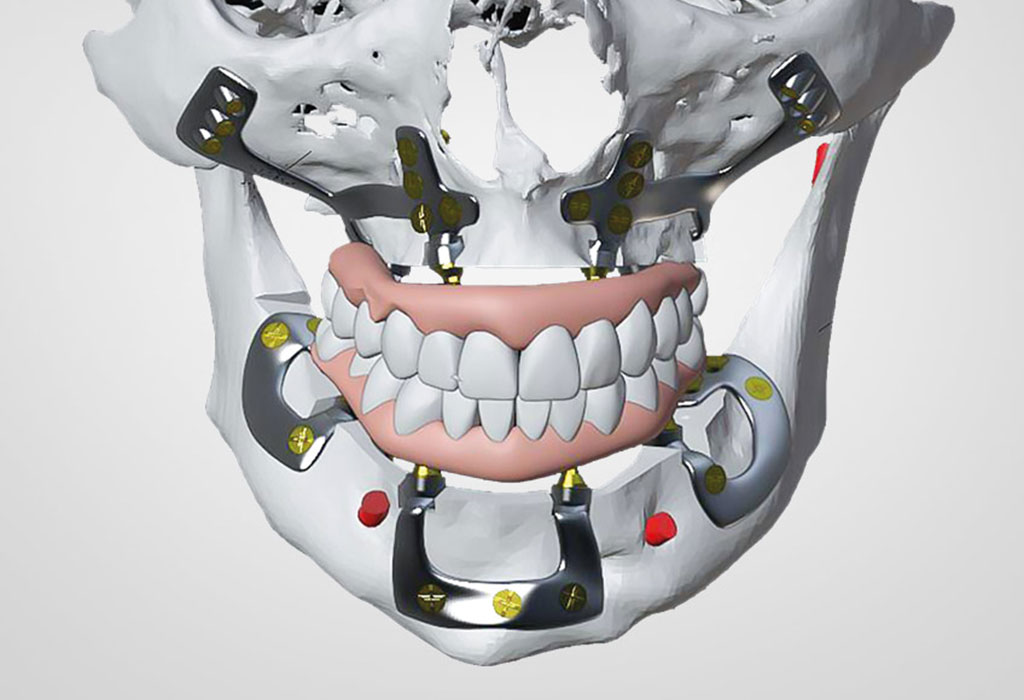 cirugía maxilofacial: implantes subperiósticos en Terrassa