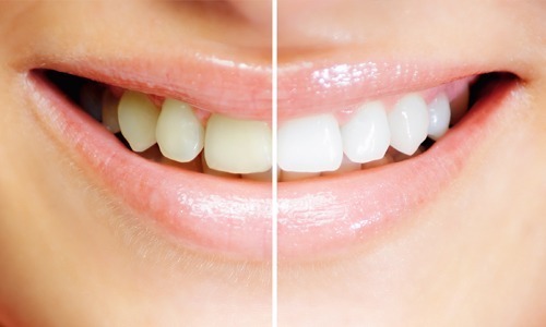 blanqueamiento dental
