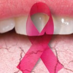 Efectos secundarios del tratamiento contra el cáncer en nuestra boca