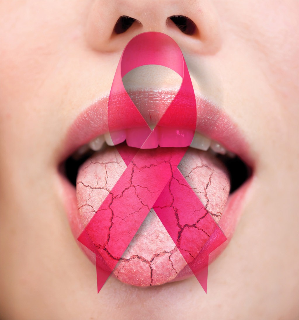 Efectos secundarios del tratamiento contra el cáncer en nuestra boca