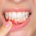 Sangrado de encías en Rubí