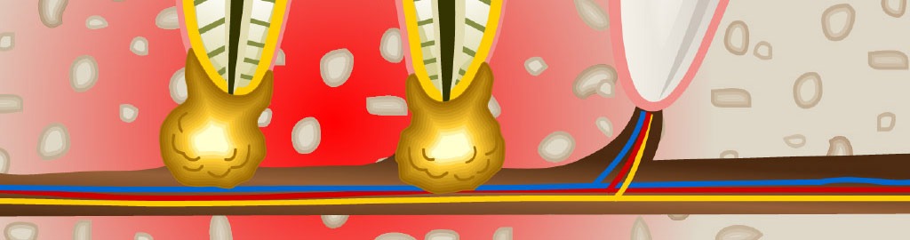 Especialistas en endodoncia en Rubí