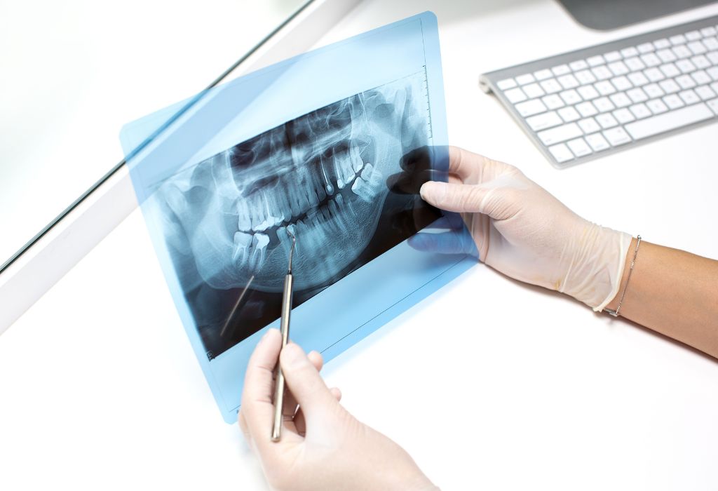 ¿Endodoncia o extracción? Cuándo merece la pena salvar un diente