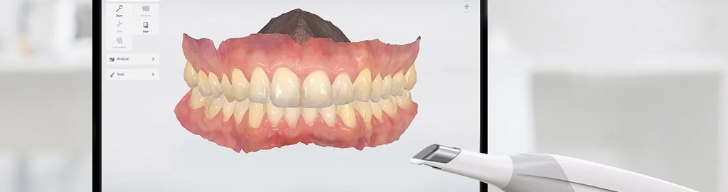 Nuevo escáner intraoral 3D