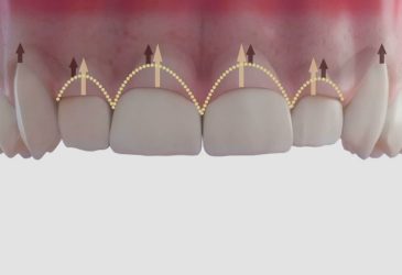 tratamiento completo en 1 visita gingivectomía
