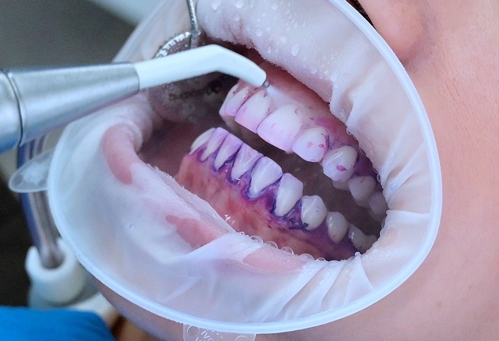 bioflow higiene dental con airflow