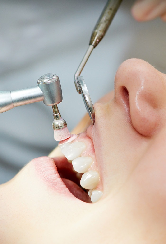 limpieza dental standard