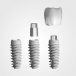 implantes dentales en Terrassa