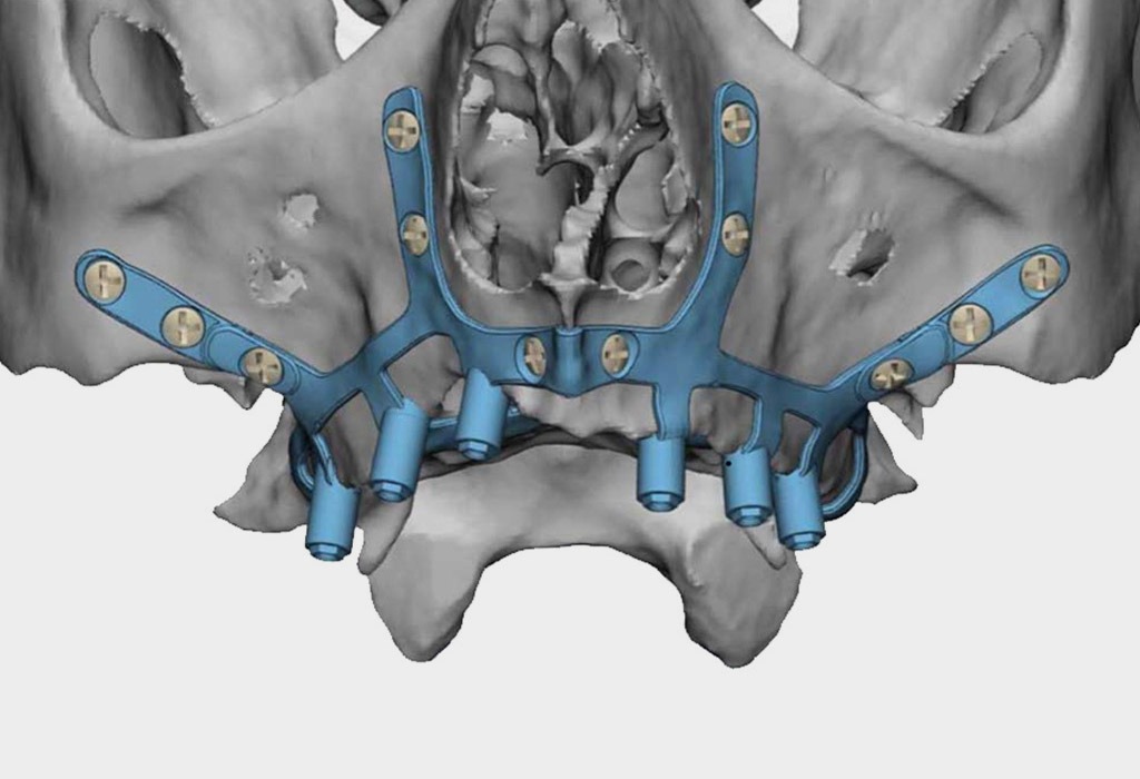 implantes subperiósticos para pacientes sin hueso implantes subperiósticos para pacientes sin hueso