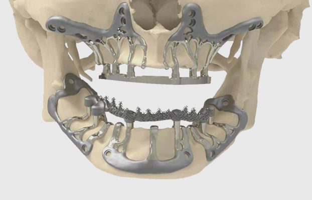 Implantes subperiósticos