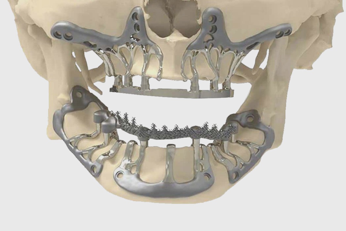 Implantes subperiósticos